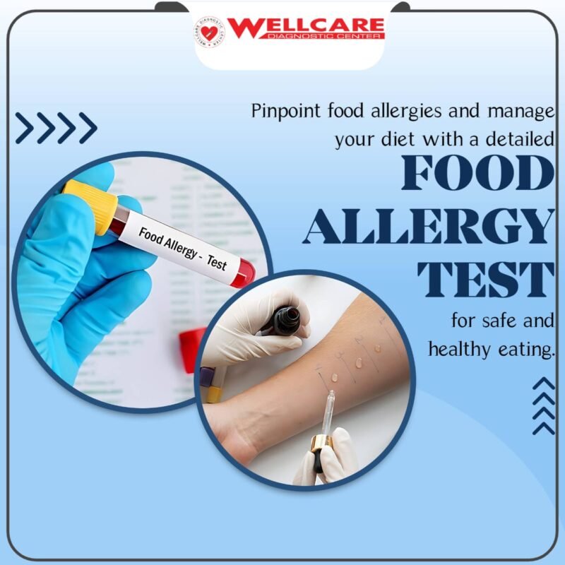 ALLERGY - FOOD (FOOD+NON VEG)